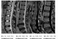 正常人椎间盘的MRI变化及可能因素对临床治疗的指导价值